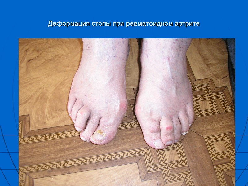 Деформация стопы при ревматоидном артрите